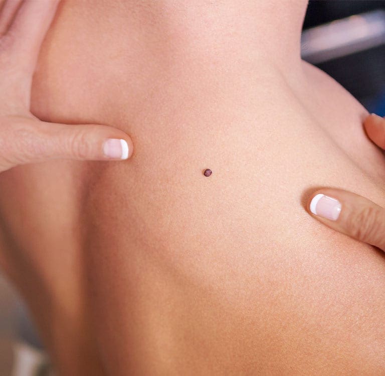 Moles and Skin Cancer